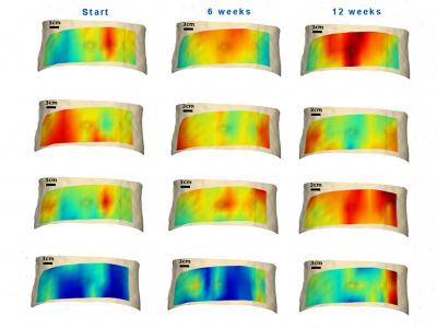 Diffuse optical spectroscopic imaging of adipose tissue metabolic changes during weight loss