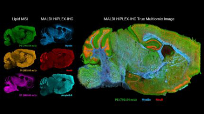 Novel multiomic imaging enhances spatial high-plex protein imaging with the ability to elucidate metabolic processes in the same tissue section. In addition to mapping tens to over one hundred targeted proteins with high-plex peptide tags, MALDI HiPLEX-IHC can track signalling pathways such as glycosylation, observe lipid spatial profiles for tumour microenvironment segmentation, or simultaneously observe how drugs affect both protein and metabolic states.